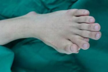 一足生9趾是怎么回事?潮汕小伙左脚生9趾买鞋都需大两码 - 逸尤格