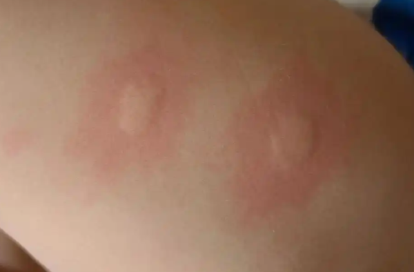 被蚊子咬后痒痛的背后,竟藏着这些秘密 - 逸尤格