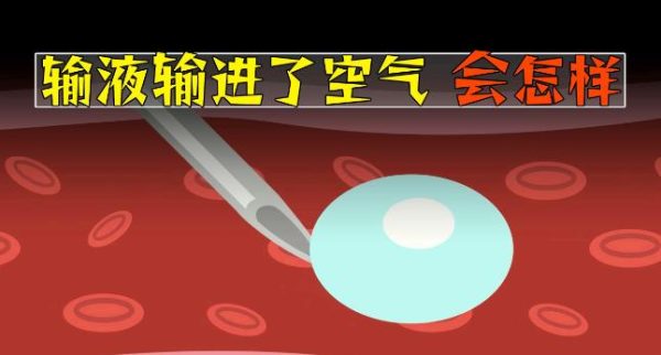 输液的时候,如果不小心输入了空气会怎样? - 逸尤格